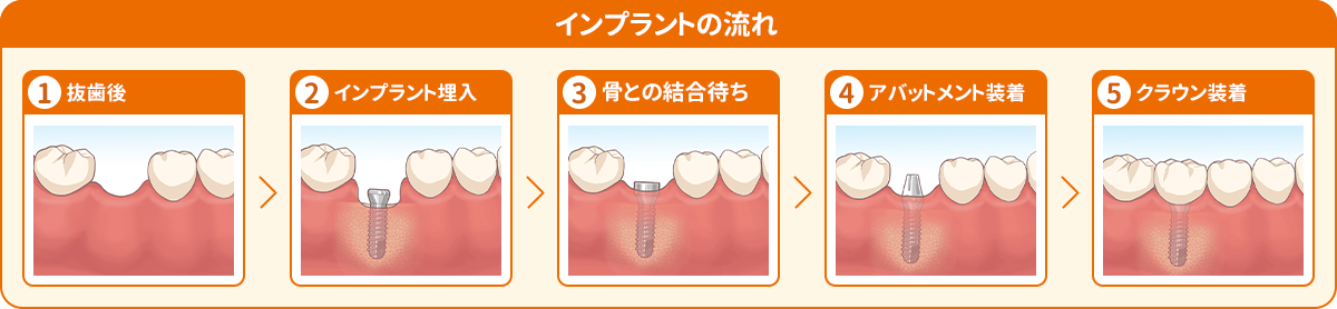 インプラントの流れ